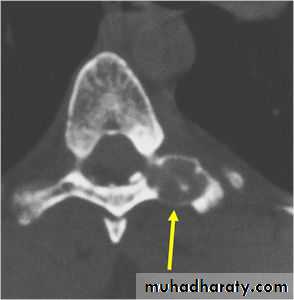 bone tumor2