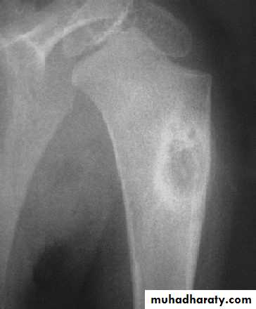 bone tumor2