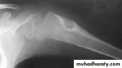 bone tumor2