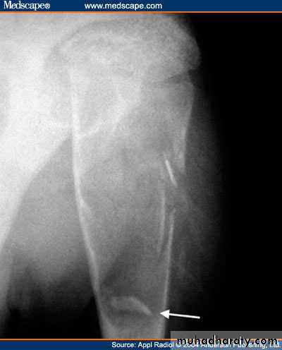 bone tumor2