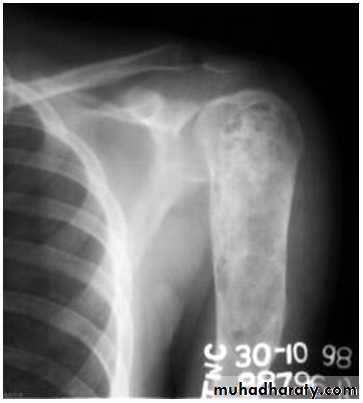 bone tumor2