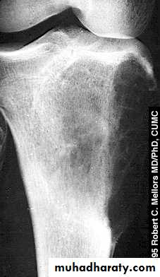 bone tumor2