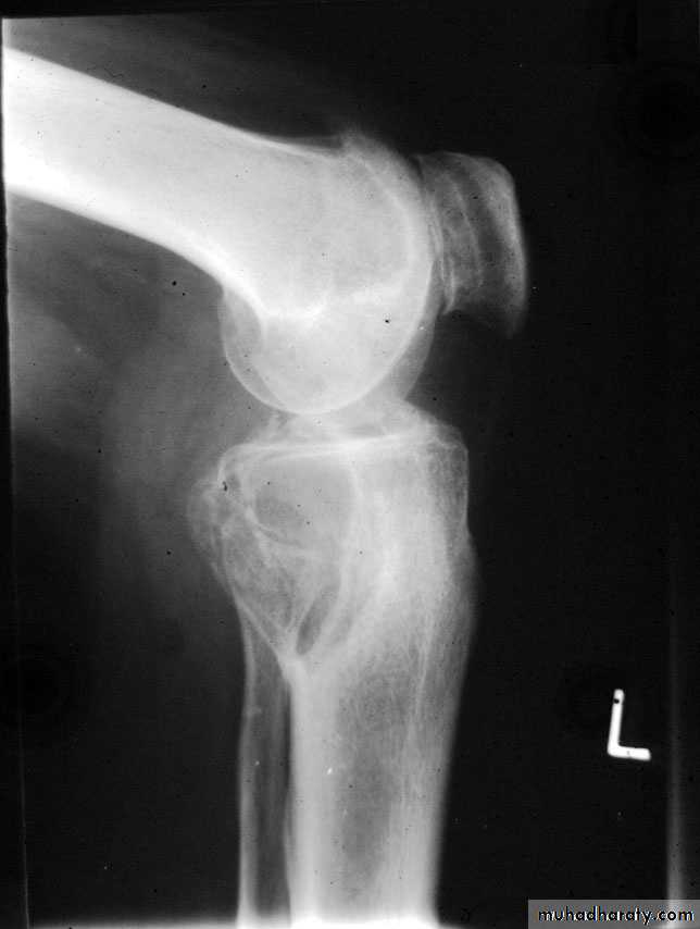 bone tumor2