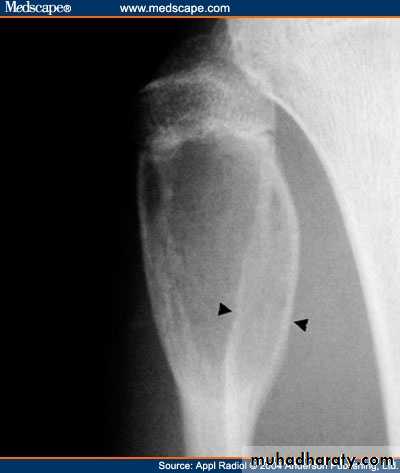 bone tumor2