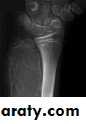 bone tumor2