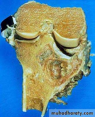 bone tumor2