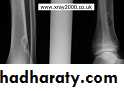 bone tumor2