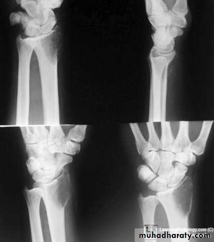 bone tumor2