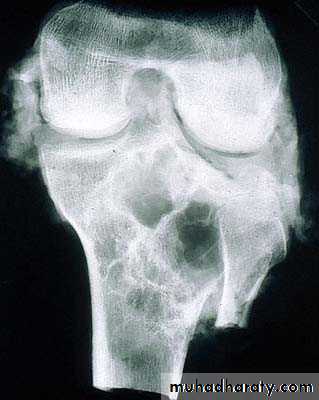bone tumor2