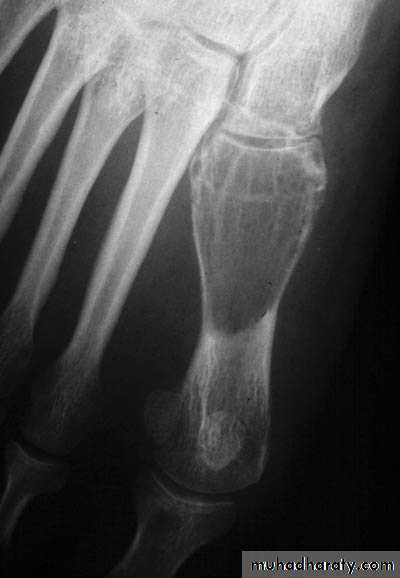 bone tumor2