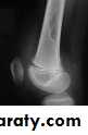 bone tumor2