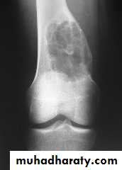 bone tumor2