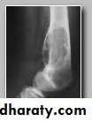 bone tumor2