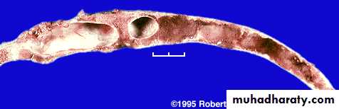 bone tumor2
