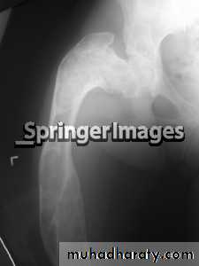 bone tumor2