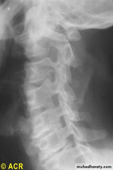 OSTEOARTHRITIS