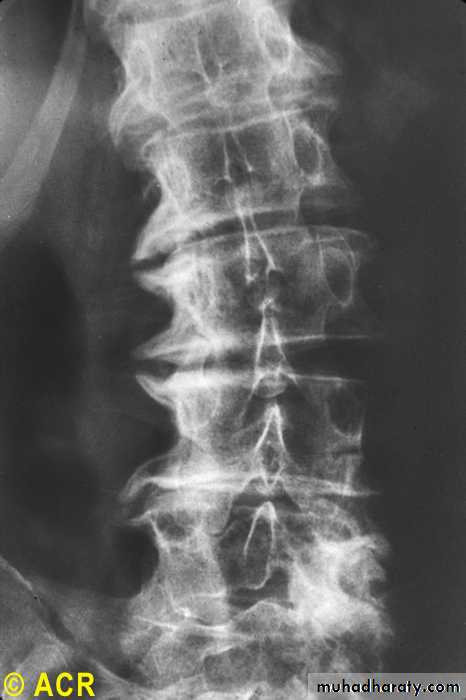 OSTEOARTHRITIS