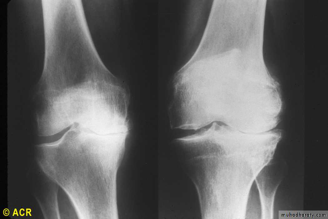 OSTEOARTHRITIS