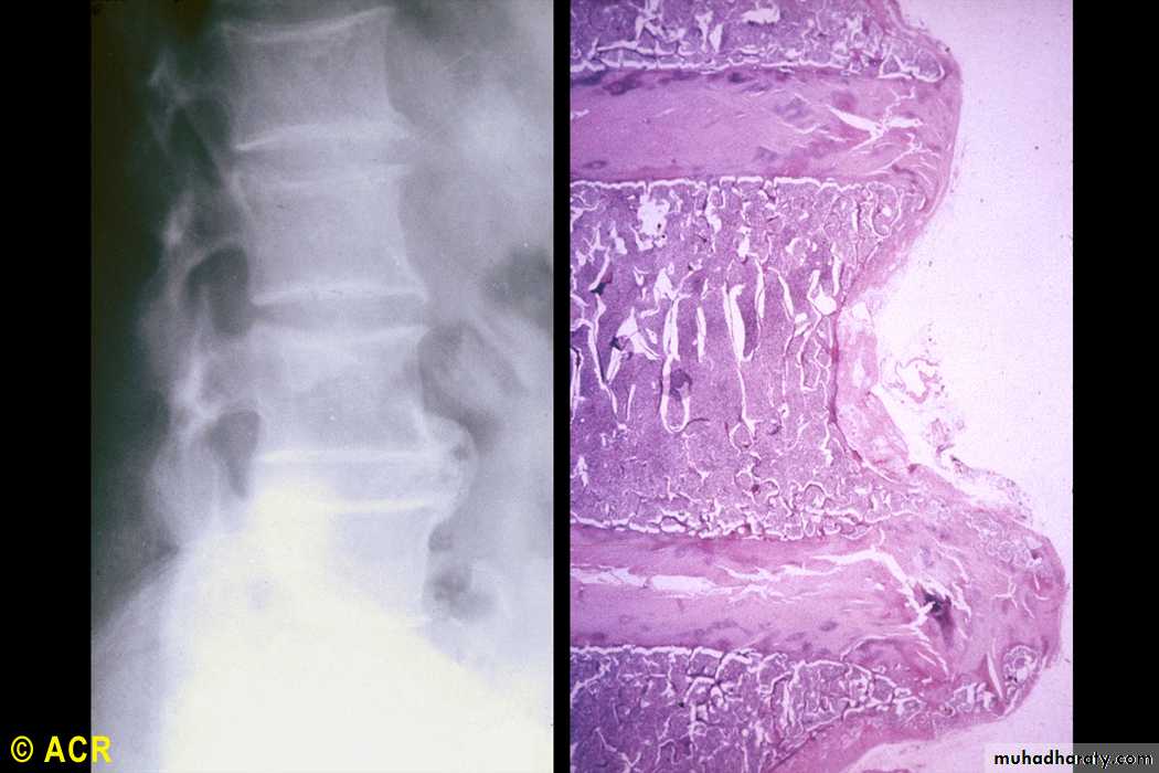 OSTEOARTHRITIS