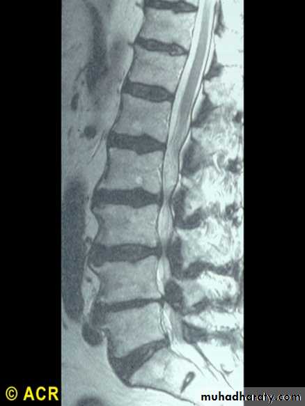 OSTEOARTHRITIS