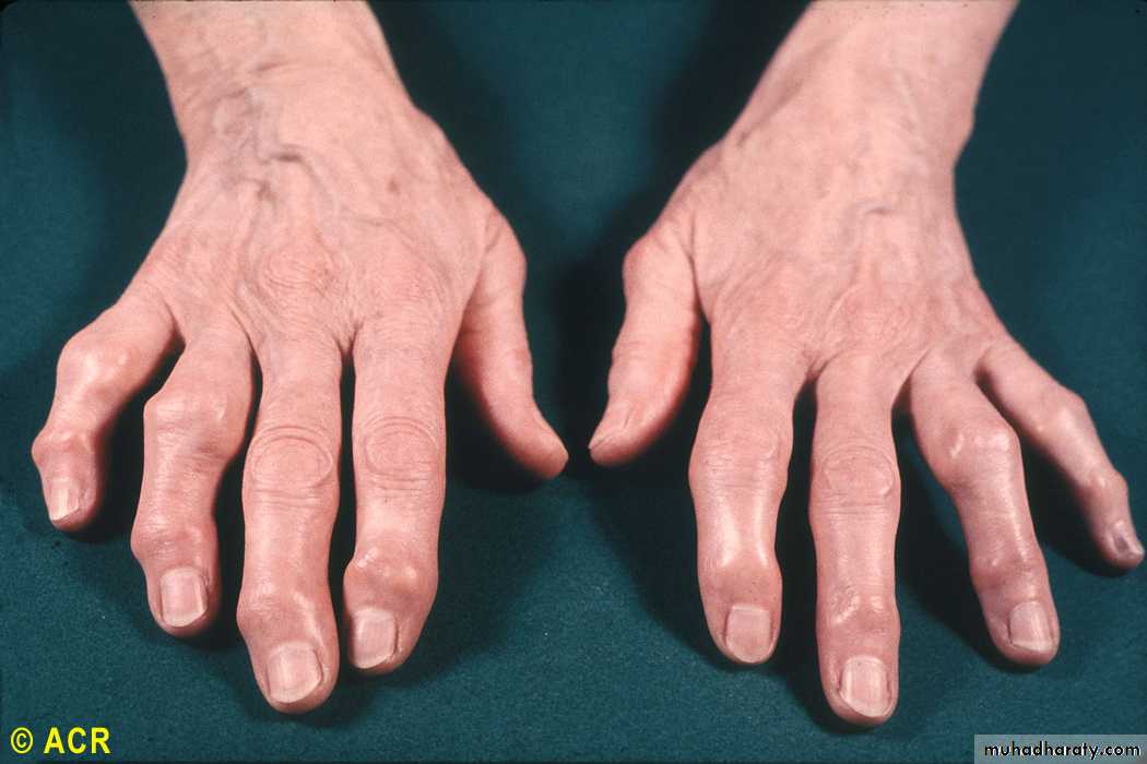 OSTEOARTHRITIS