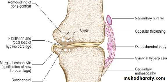 OSTEOARTHRITIS