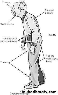 movement disorder