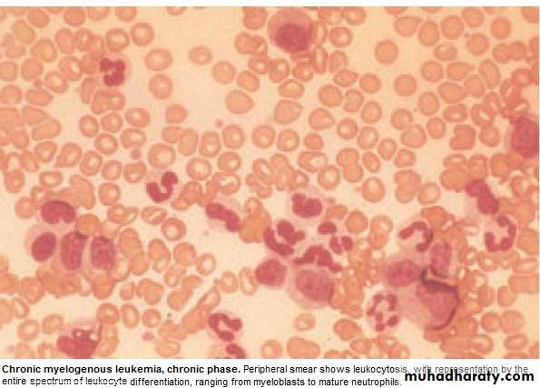 lymphomas