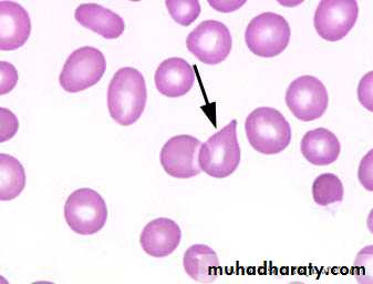 lymphomas