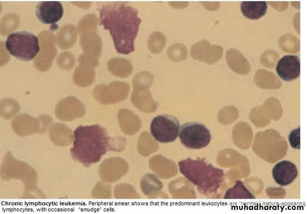 lymphomas