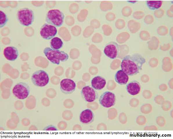 lymphomas