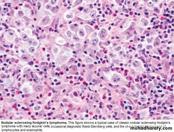 lymphomas