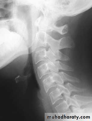 Injuries of the thoracic spine