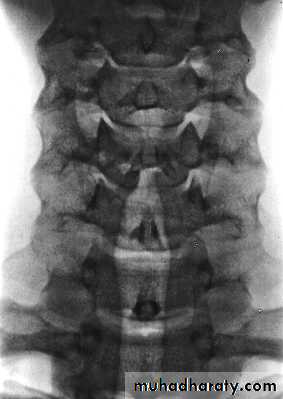 Injuries of the thoracic spine