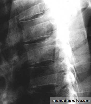 Injuries of the thoracic spine
