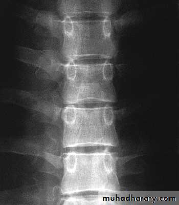 Injuries of the thoracic spine