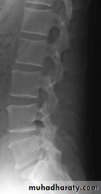Injuries of the thoracic spine
