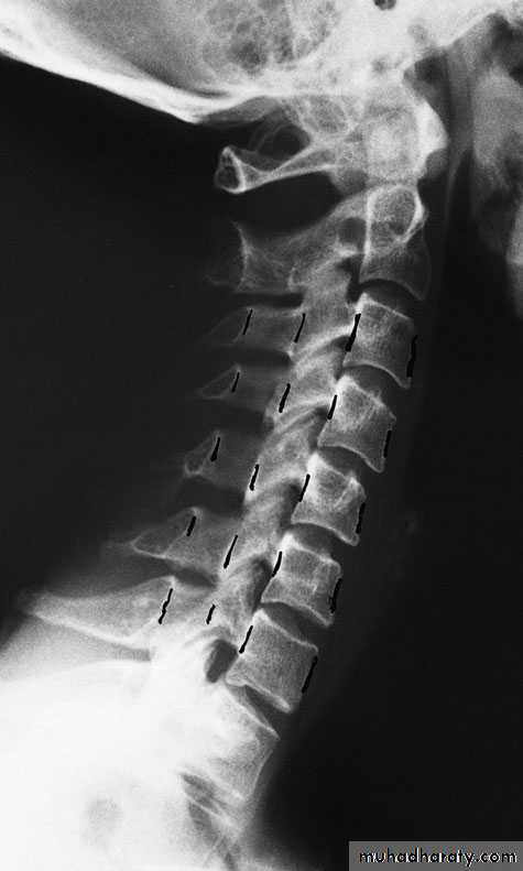 Injuries of the thoracic spine