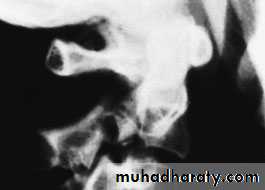 Injuries of the thoracic spine