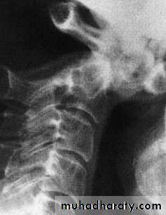 Injuries of the thoracic spine