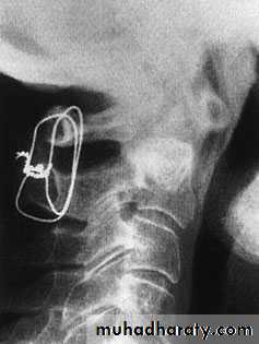 Injuries of the thoracic spine