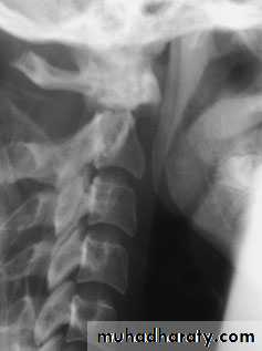 Injuries of the thoracic spine