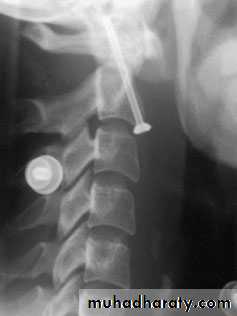 Injuries of the thoracic spine