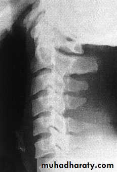 Injuries of the thoracic spine