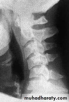 Injuries of the thoracic spine