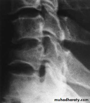 Injuries of the thoracic spine