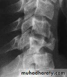 Injuries of the thoracic spine
