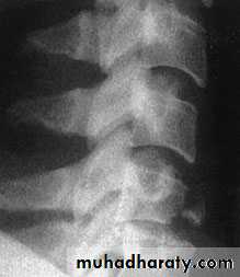 Injuries of the thoracic spine