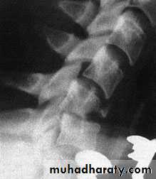 Injuries of the thoracic spine