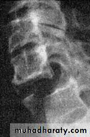 Injuries of the thoracic spine